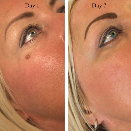 TaggyMax – No More Skin Tags