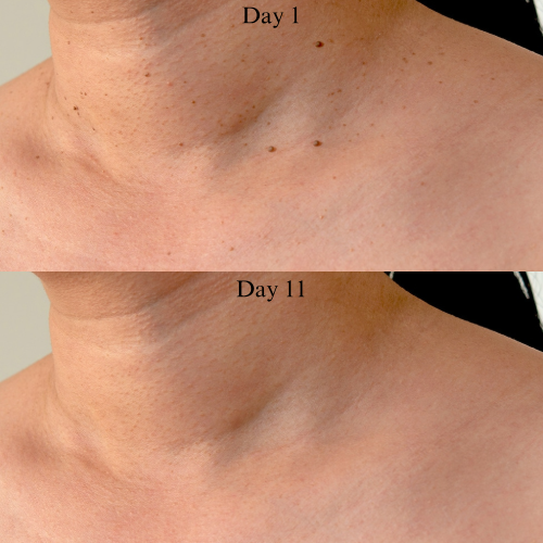 TaggyMax – No More Skin Tags